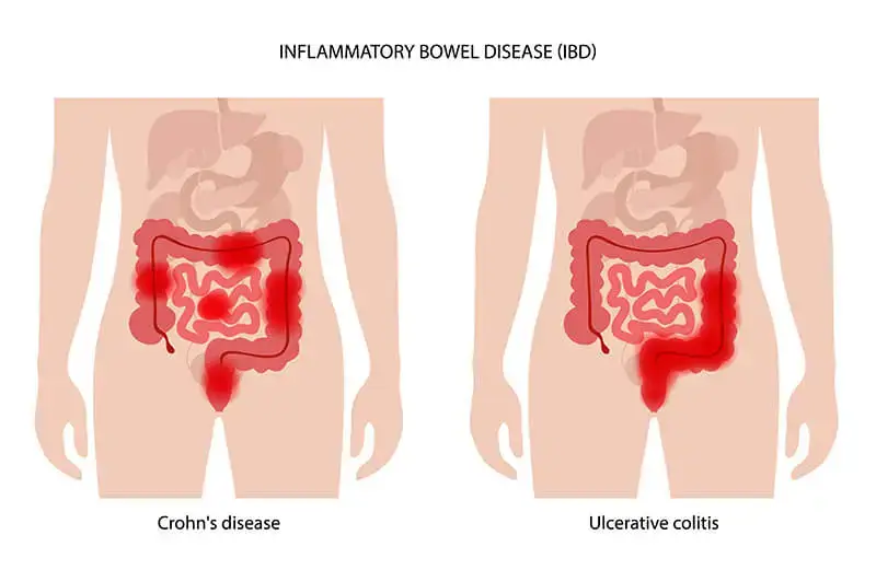 Inflammatory bowel