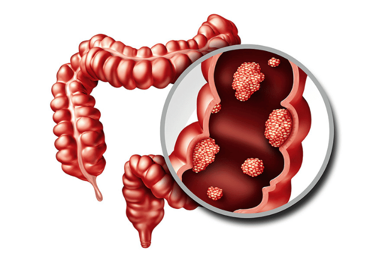 What is colon cancer? Treatment and Symptoms