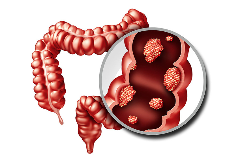 Rectal Cancer: Signs, & Treatment