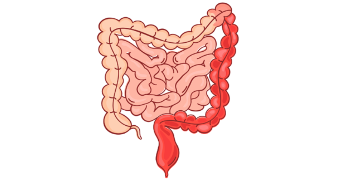 What are the stages, signs, and symptoms of ulcerative colitis?