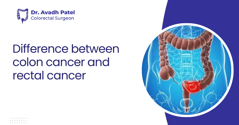 Difference Between Colon Cancer And Rectal Cancer