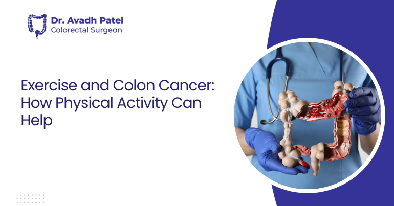 Exercise and Colon Cancer: How Physical Activity Can Help